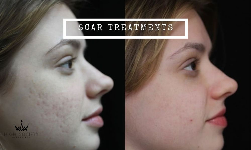 Visit High Society Aesthetics for the Best Scar Treatment