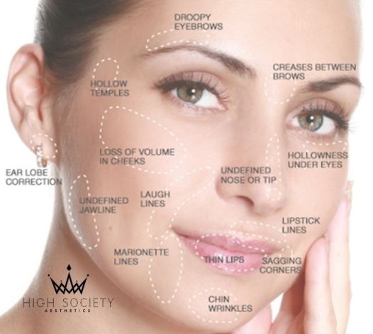 Improve Your Facial Features with Needle-Free Dermal Fillers Perth Treatment