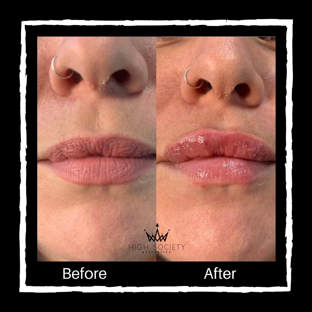 Where to Get the Best Lip Augmentation?